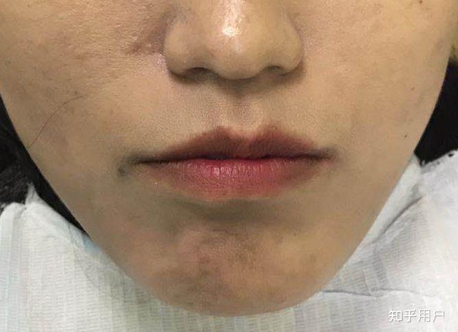 嘴角完全不对称!要怎么矫正? - 知乎