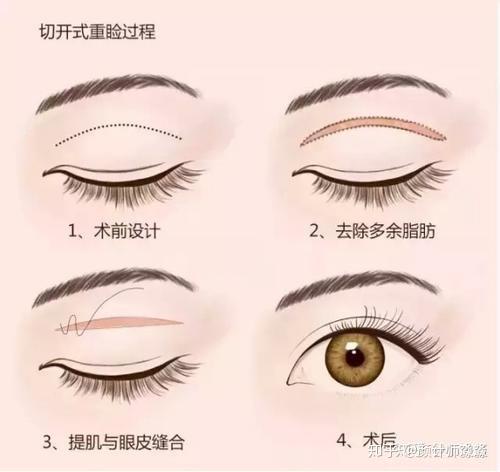 什么是双眼皮埋线手术 v2-da86f0684023fddadb306f7efe7d2490_r.jpg