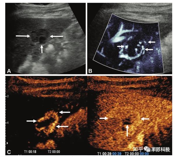 2022年第83期(Radiology): 微血管血流成像:临床应用现状和前景 - 知乎