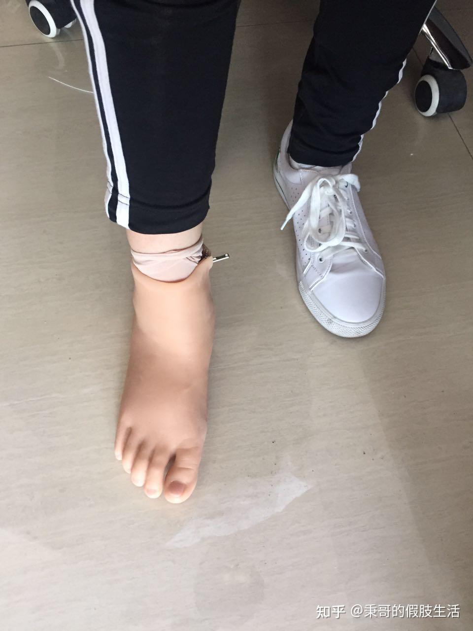 踝部截肢后应穿戴什么样的假肢? - 知乎