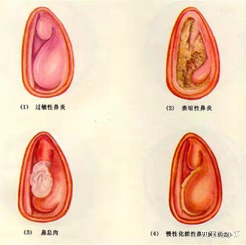 鼻塞的时候鼻子是什么样的?是什么东西堵住的?