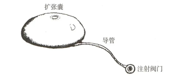 扩张器|一期、二期手术简介 - 知乎