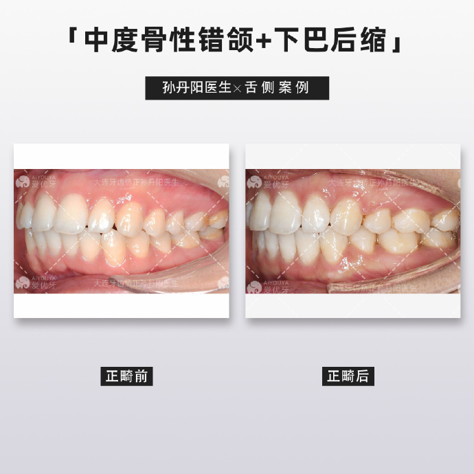 大连牙齿矫正:舌侧矫正与传统唇侧相比有哪些优点?安利一波舌侧矫正!!! - 知乎