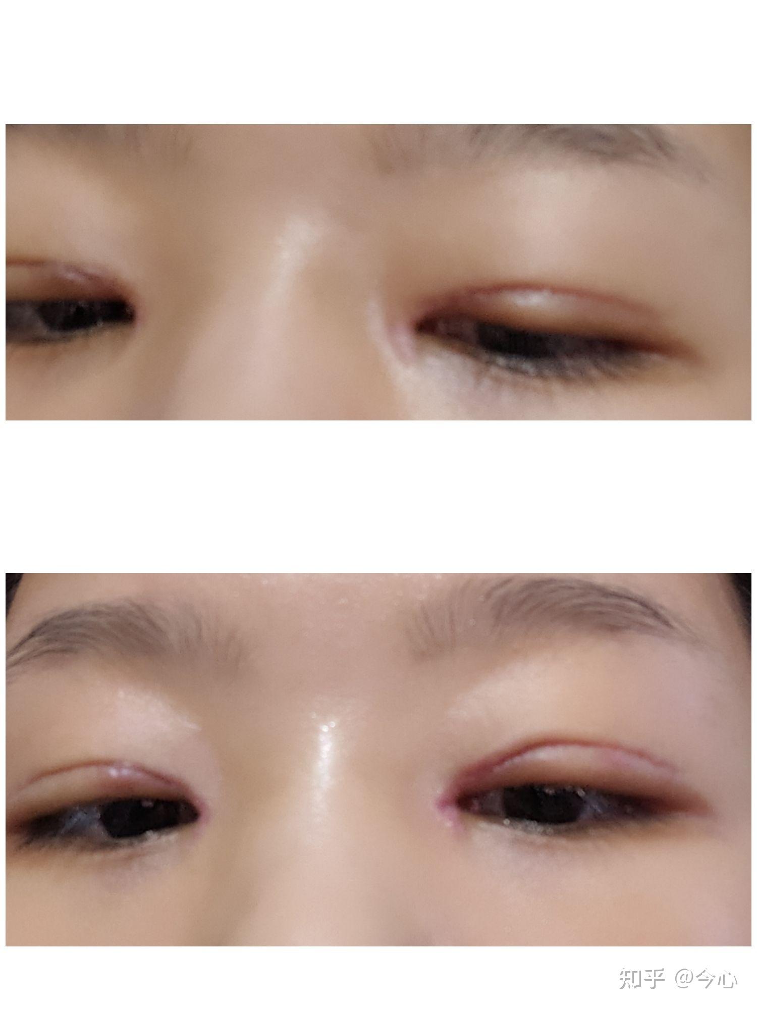 全切双眼皮加开眼角两个月了,眼角白色疤痕明显,请问各位这个情况需要