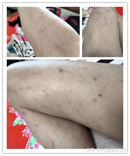诊断结果为疑难性的免疫系统皮肤病,全身瘙痒难受,溃烂