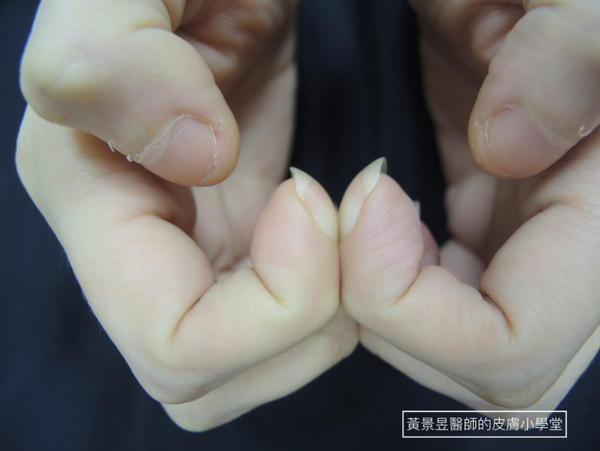 我的指头变成打鼓棒了? 别小看“杵状指”带给你的杯具! - 知乎