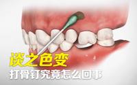 骨钉一个月打了又拔 支抗钉有多遭罪 知乎