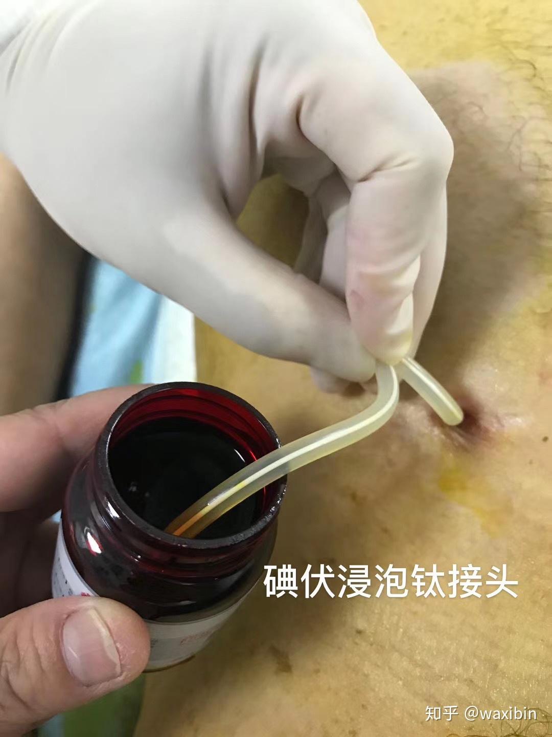 双导丝引导复位一种新的腹膜透析导管移位的处理方法