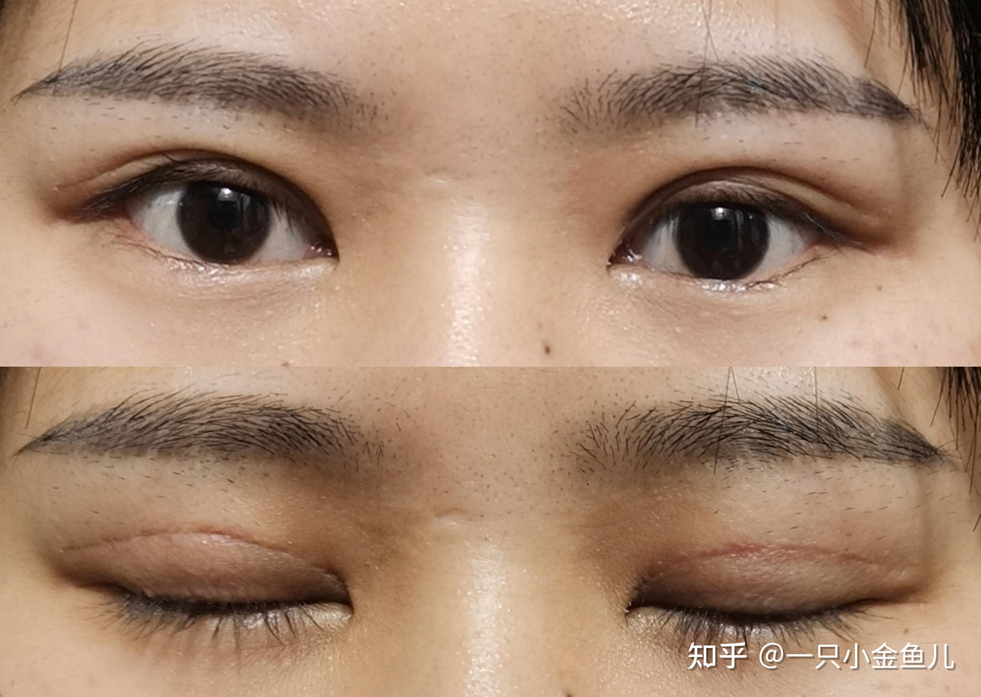 双眼皮修复宽改窄