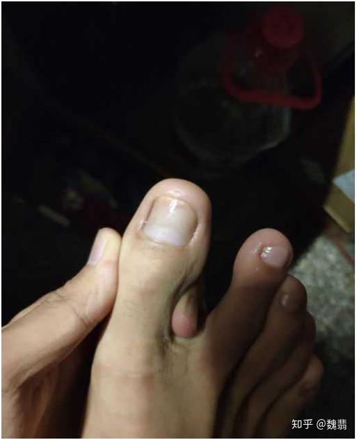 灰指甲怎样去治疗 v2-db0ecf0f8e7373dbef60e7deae0448a0_r.jpg