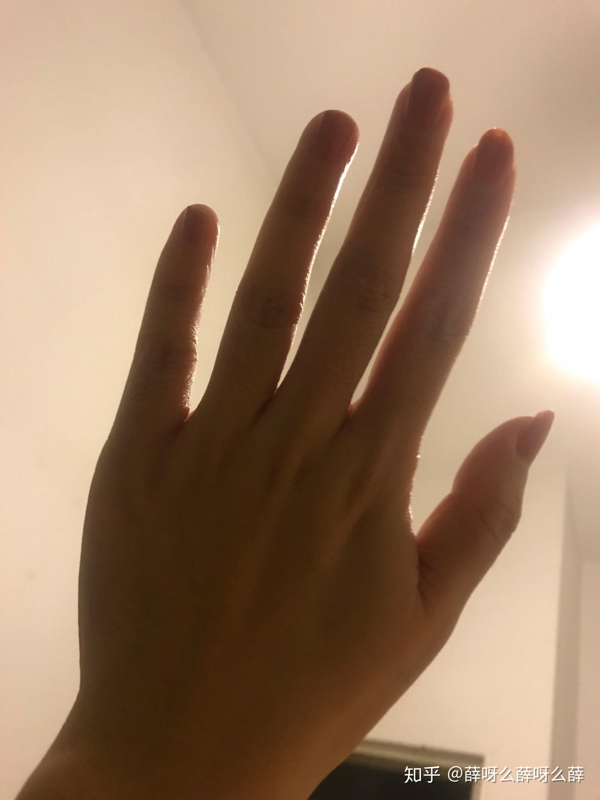 小孩子的手和老人一样干枯多皱纹是怎么回事