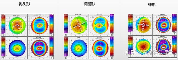 圆锥角膜的RGP验配及RGP临床效果分析（文字版） - 知乎