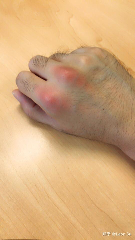 多年以来指关节经常会皮肤表面红微热活动时有疼痛感这是什么原因