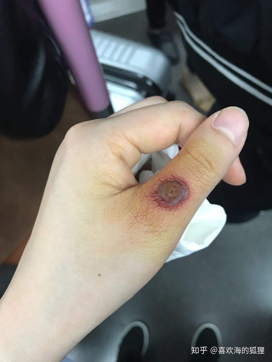 手上长了个小肉球不知道该肿么办求大神帮忙