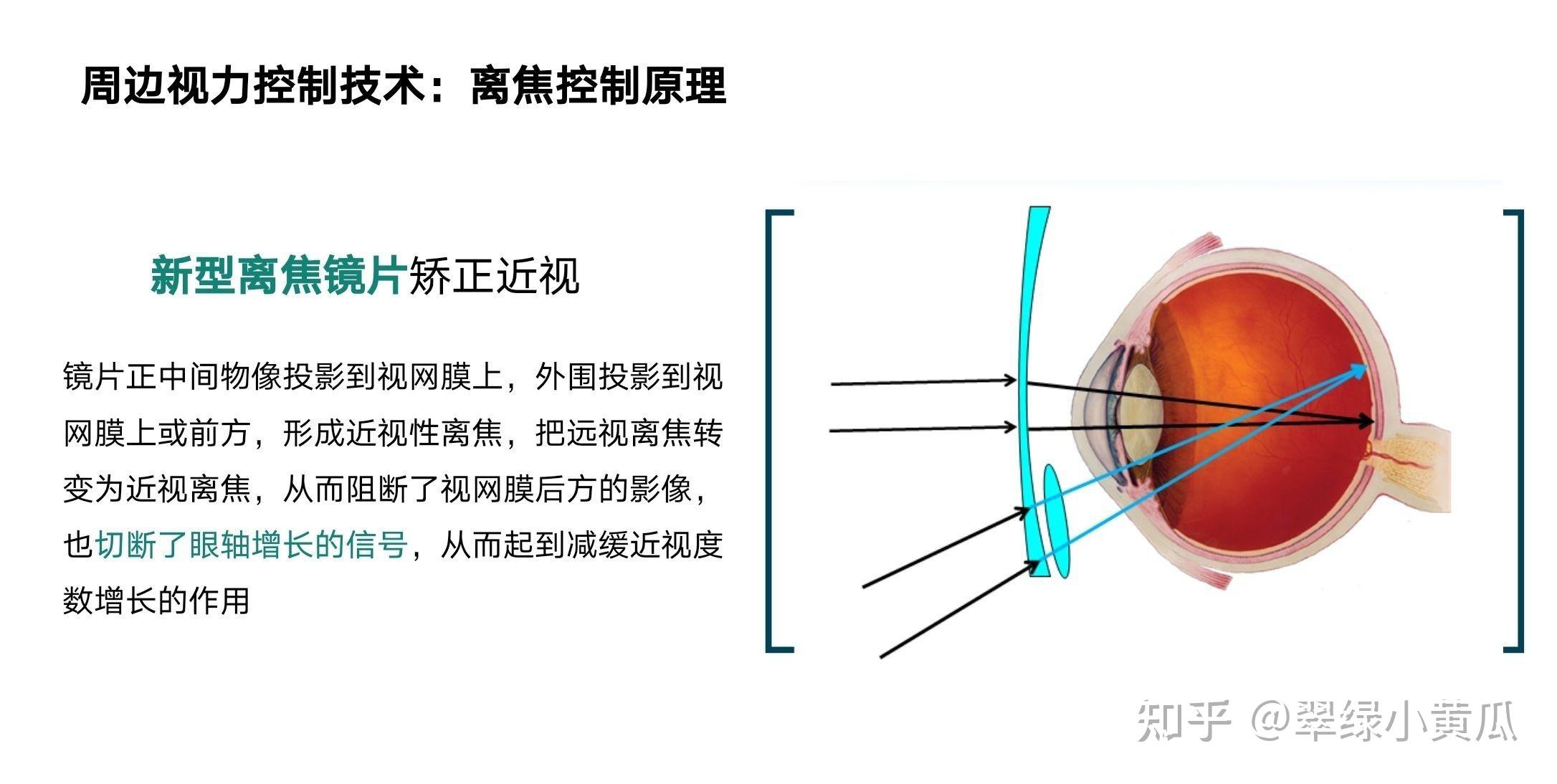 离焦镜片真的有用吗? - 知乎