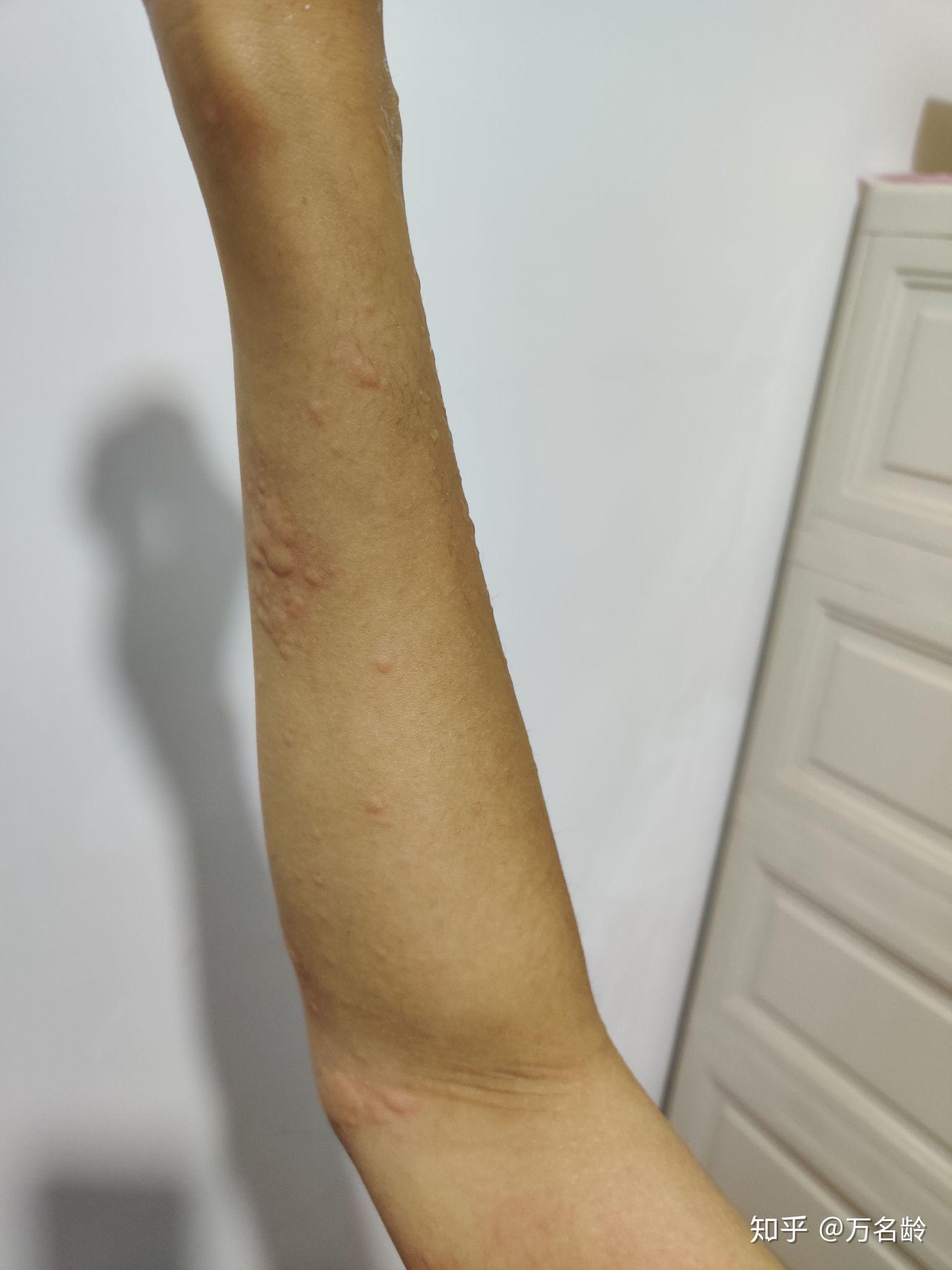 对狗过敏的症状有哪些
