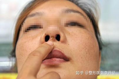 隆鼻植入假体老了之后会有危害吗