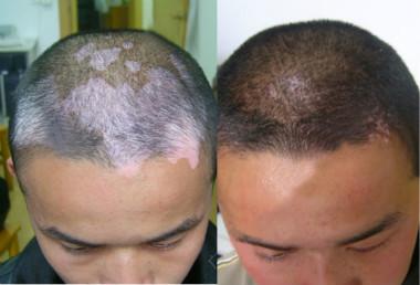 色素脱失性白斑怎么办 v2-db75d69aaec716f227fbdb28e5fbc77b_1440w.jpg?source=172ae18b