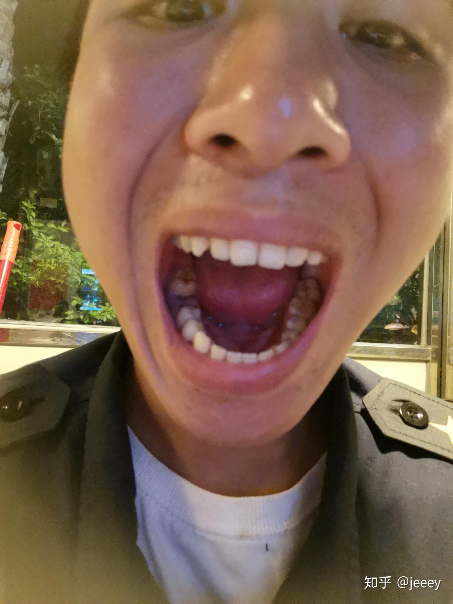 习惯用嘴巴呼吸会变丑20191219日现在还是纠正