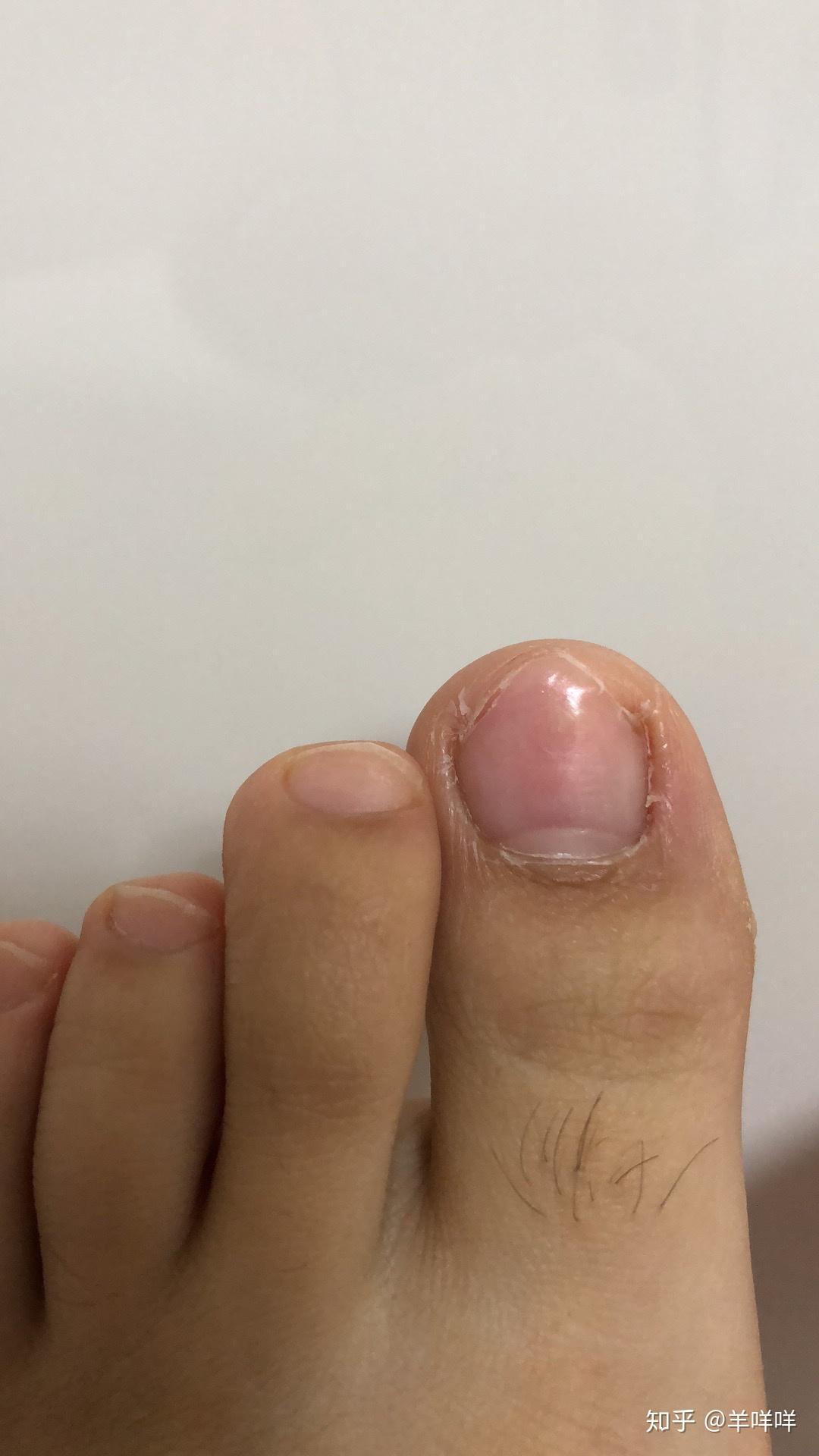 甲分离型灰指甲治愈过程