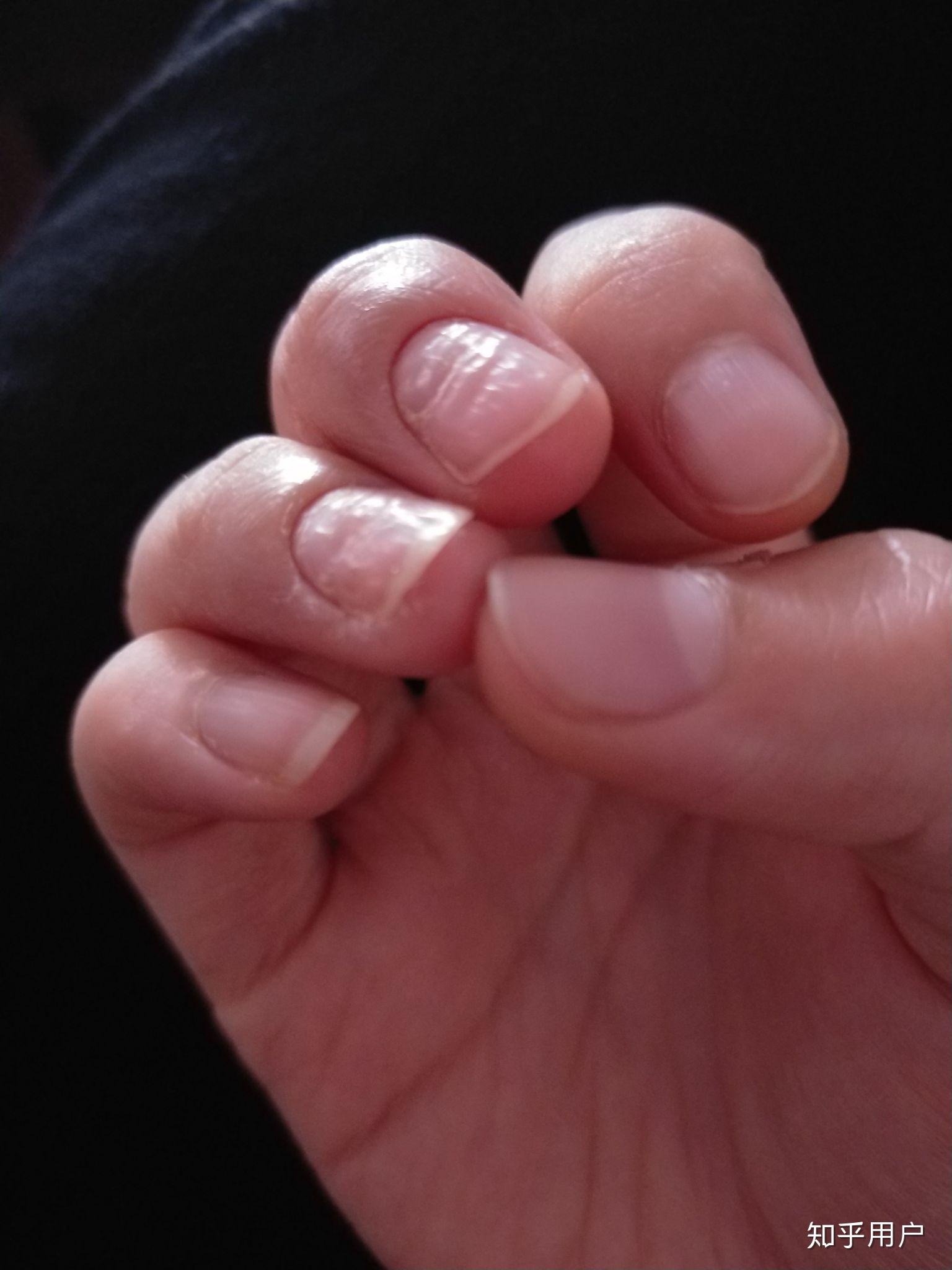 手指甲凹凸不平没检查出原因