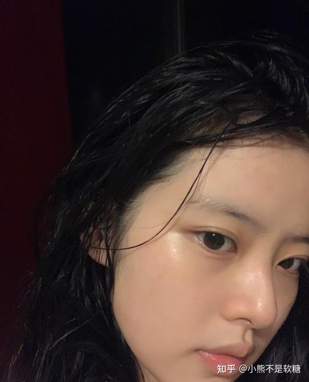 痘印不要药多久会消失?