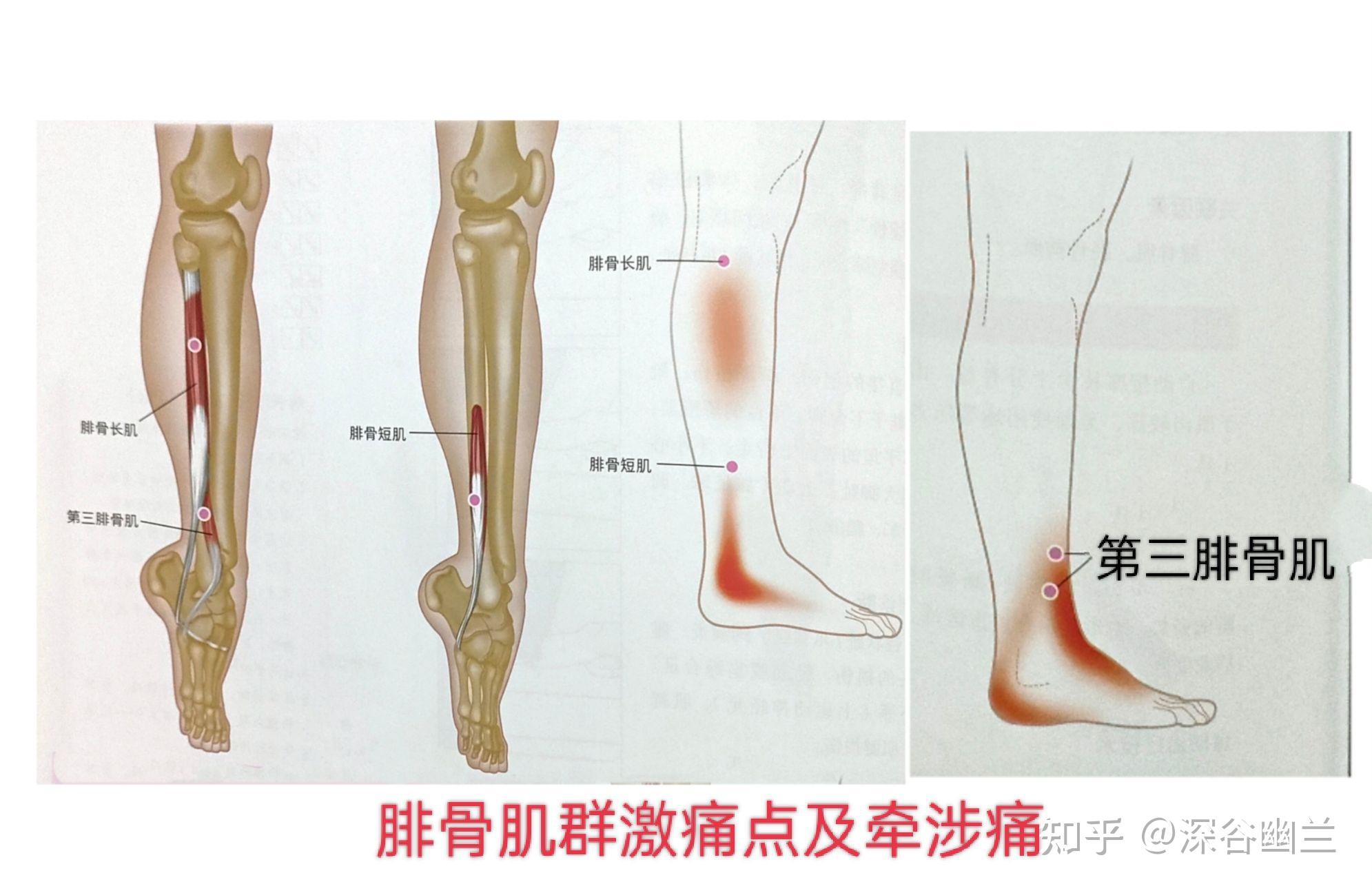 踝关节疼痛有关的激痛点及穴位