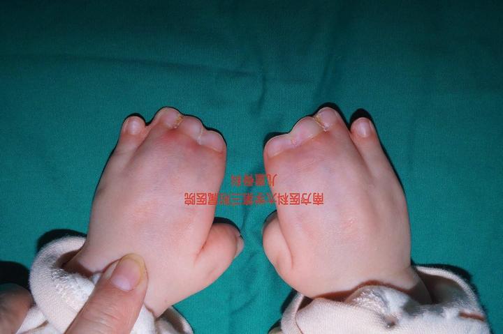 大龄宝妈图省钱不做产检新生宝宝手足并指畸形早发现早治疗