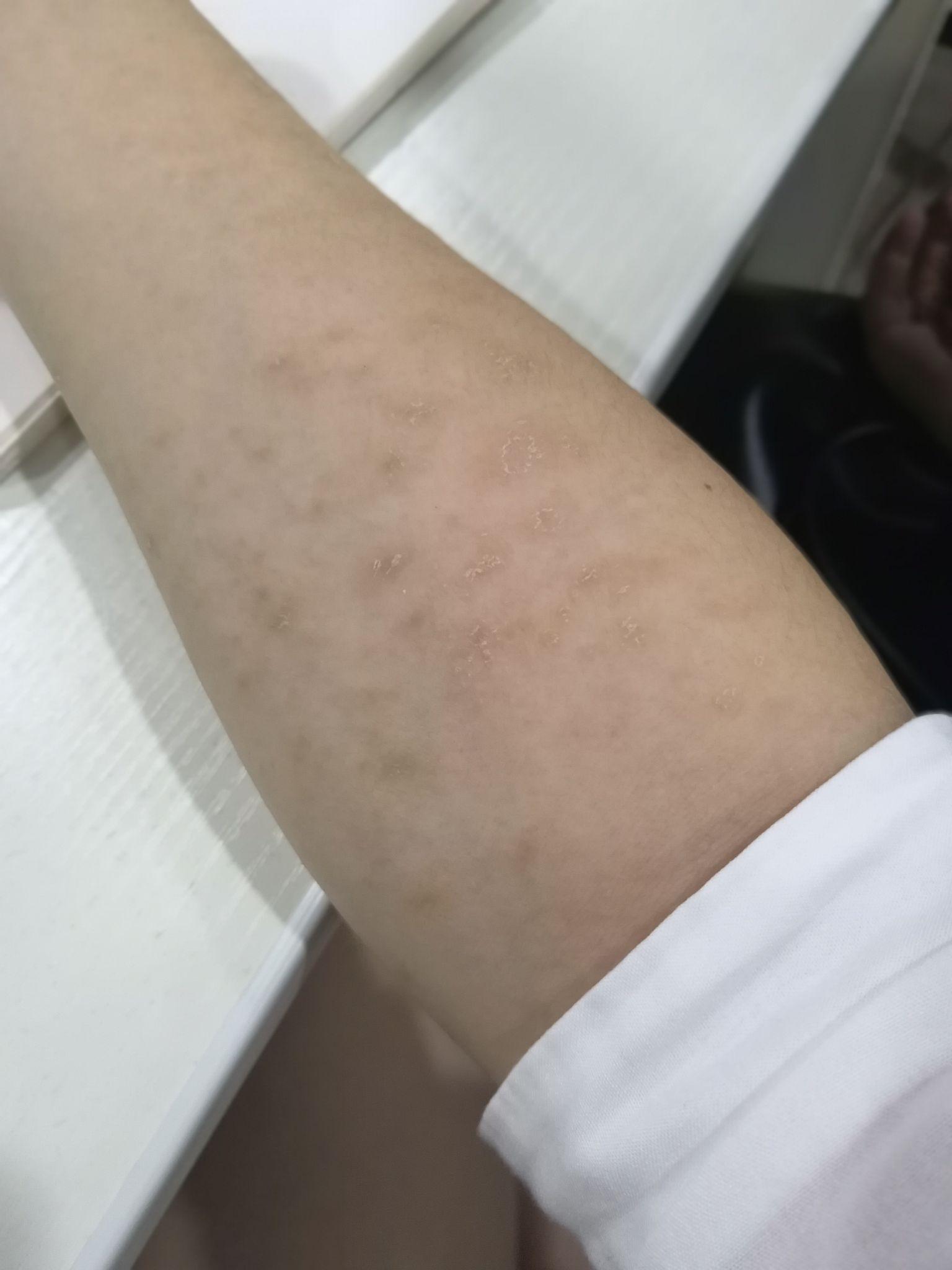 玫瑰糠疹能治好吗 知乎