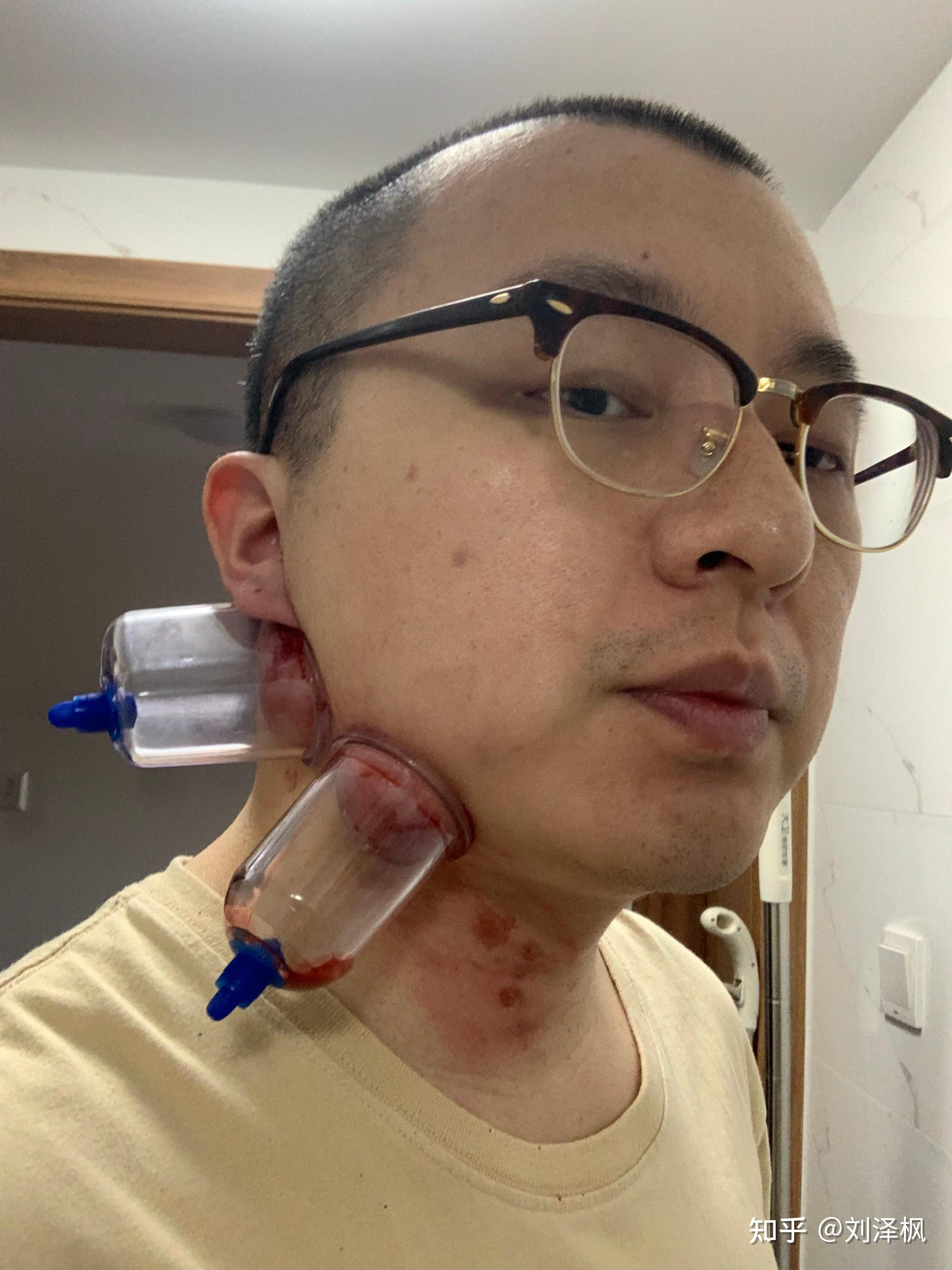 带状疱疹长脑袋上了