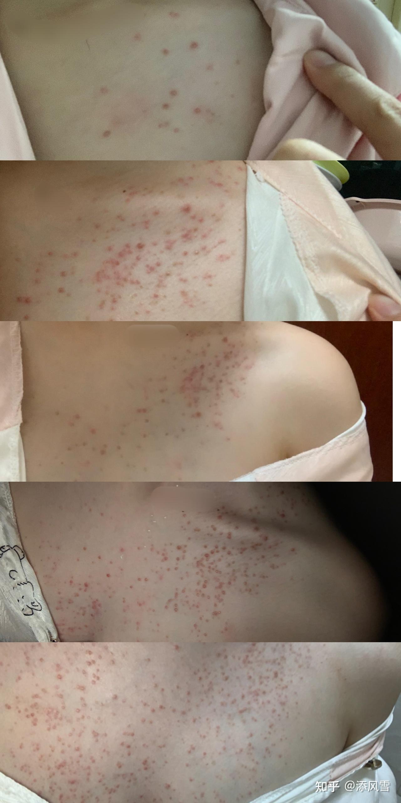 马拉色菌毛囊炎该怎么治疗