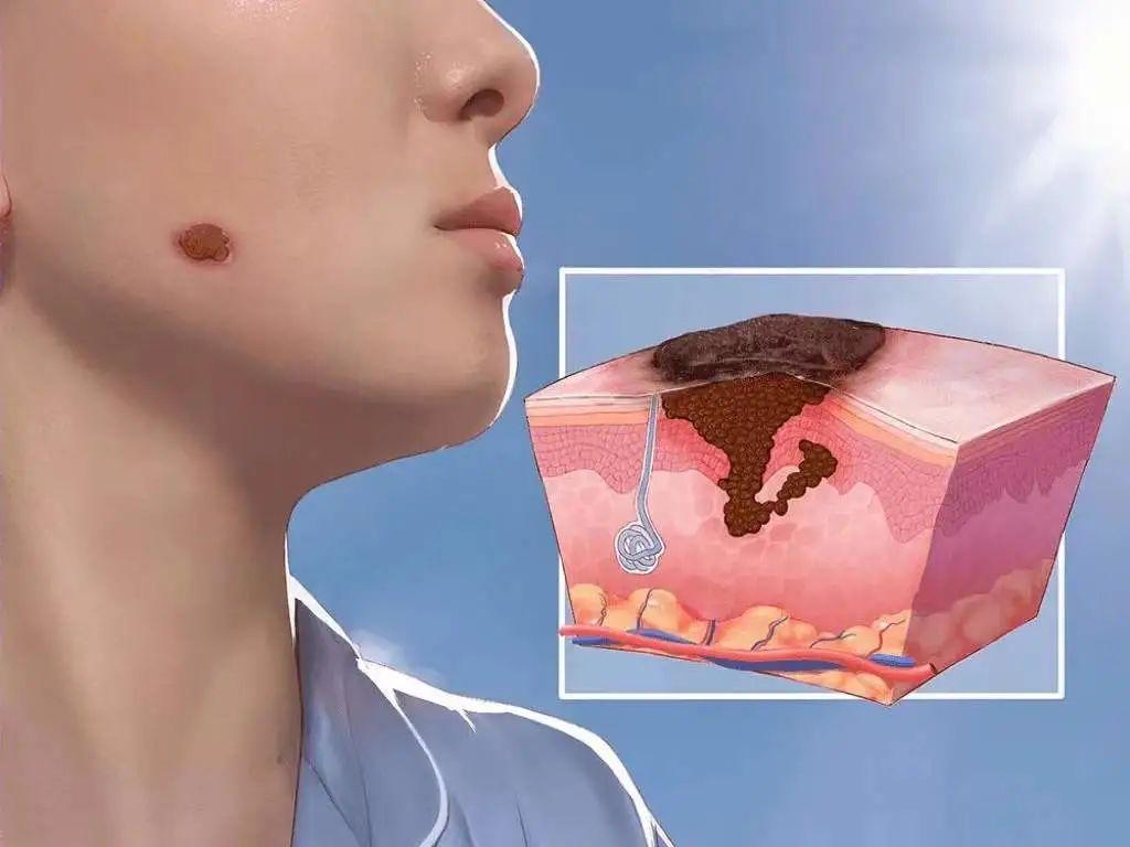 什么样的痣可能是皮肤癌快对照这几点排除