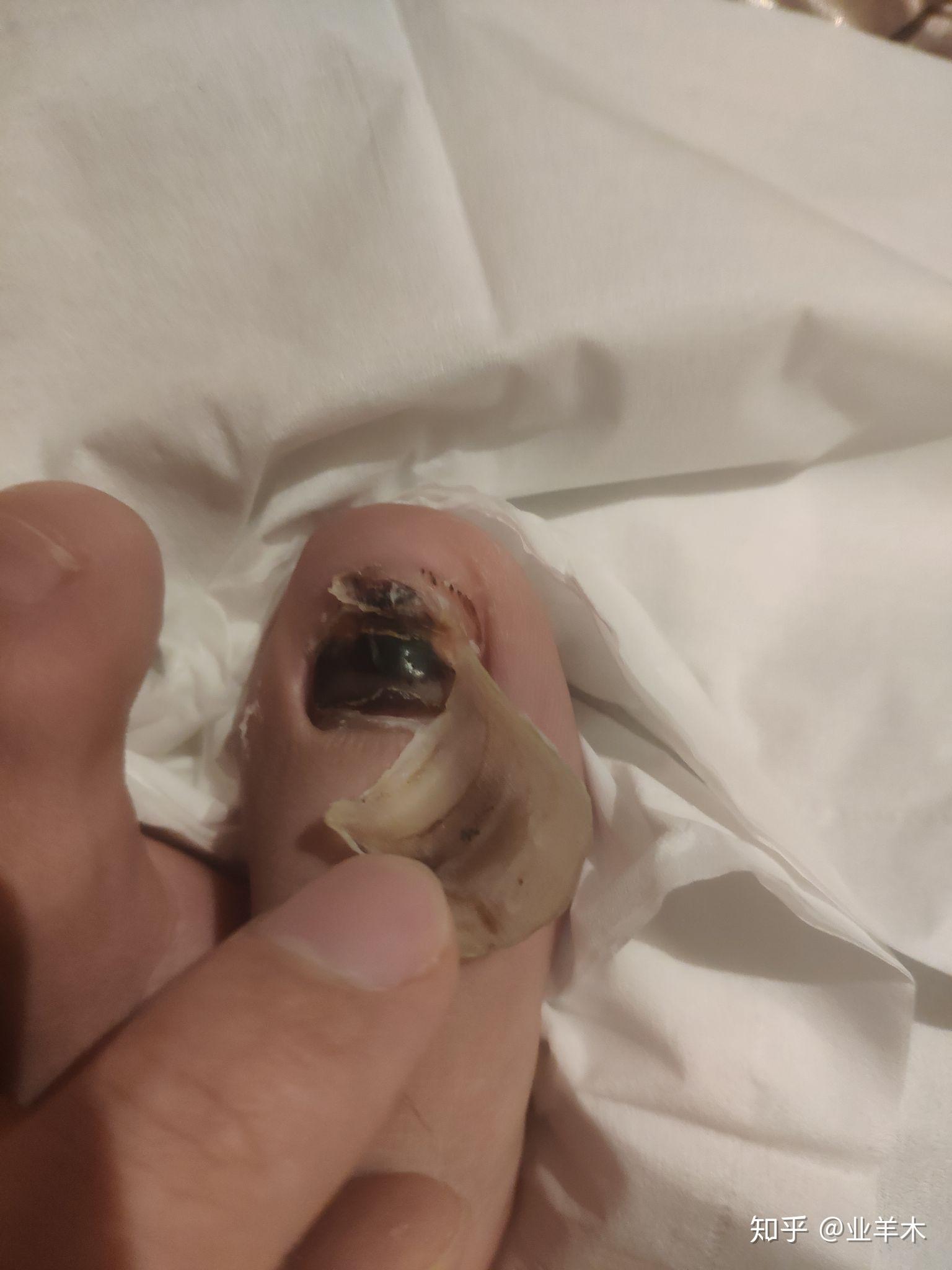 脚趾甲要脱落了下面那层已经长出来了但是上面那层就是不掉都一个月了