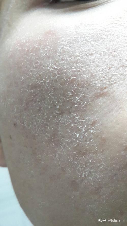 到了冬天脸上干到起皮,用什么都感觉没用,水乳刚涂