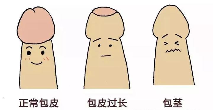 一张图教你快速判断是否包皮过长!