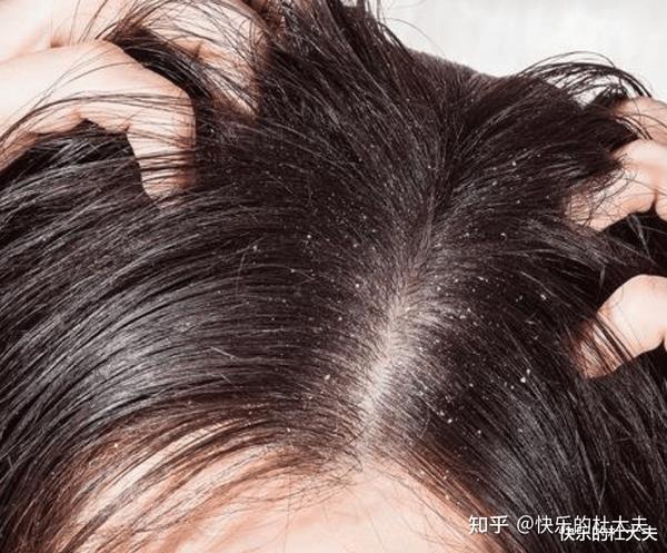 天天洗头还有头皮屑?医生:或是干性头皮,两者相似,疗法不同 - 知乎
