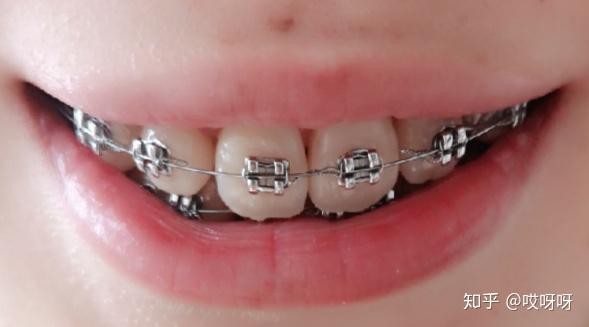 正畸分享虎牙埋伏牙
