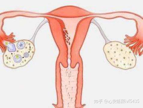 一分鐘全面瞭解卵巢過度刺激綜合症