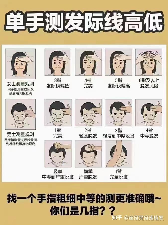 19岁这个发际线算不算高
