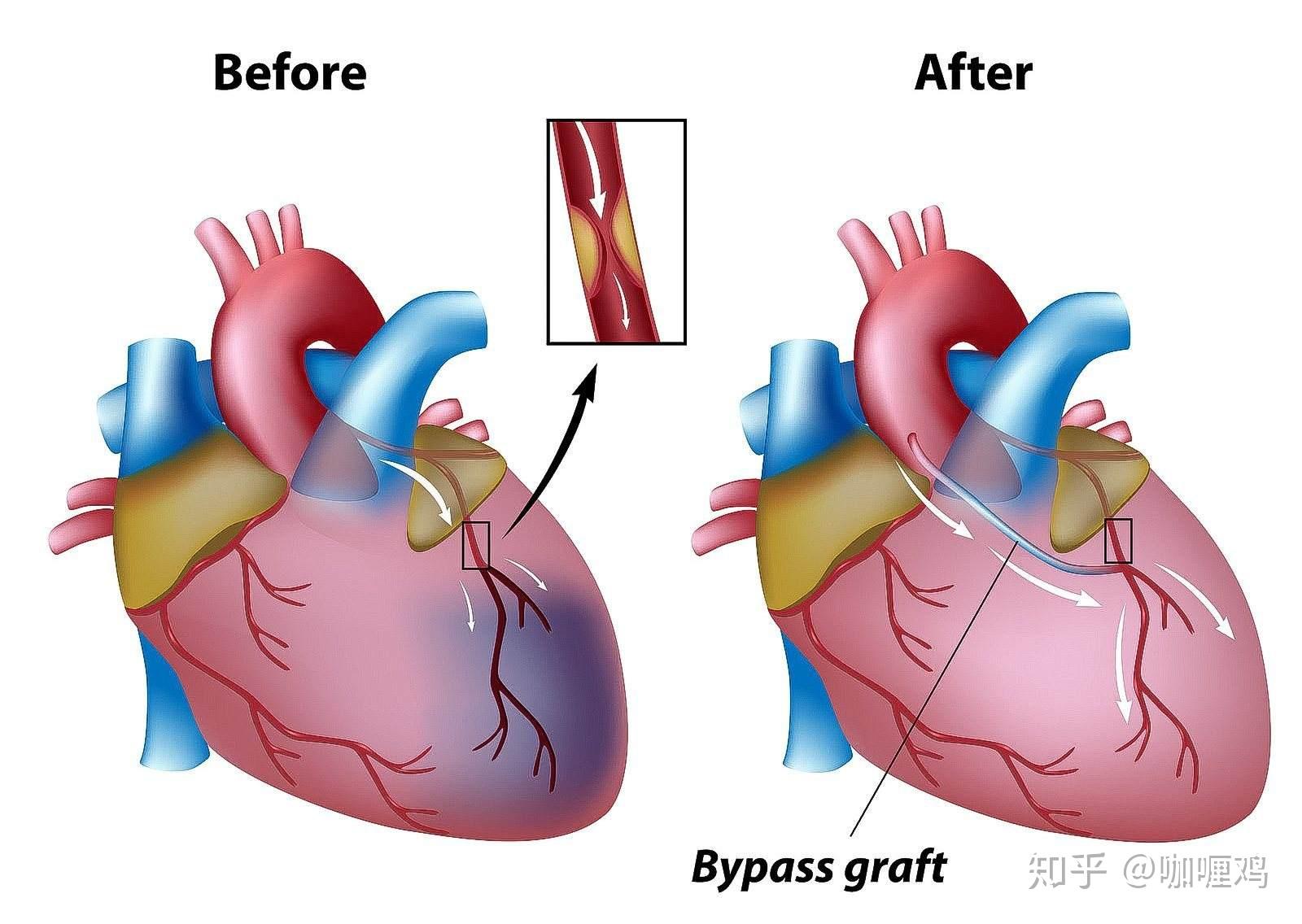 心脏搭桥手术 示意图图片