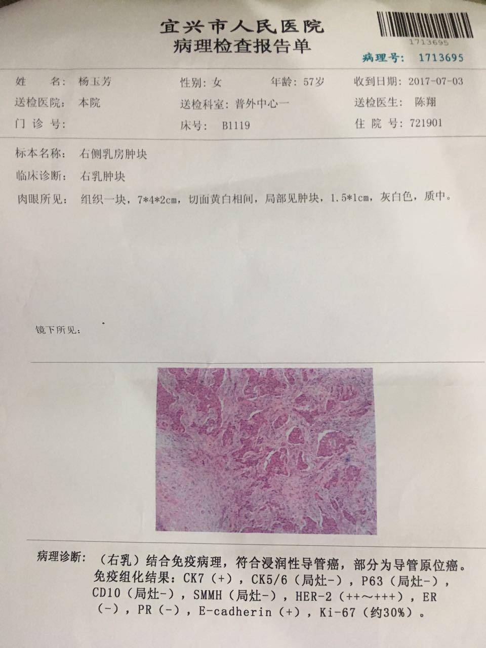 浸润性导管癌部分导管原位癌是否需要靶向治疗