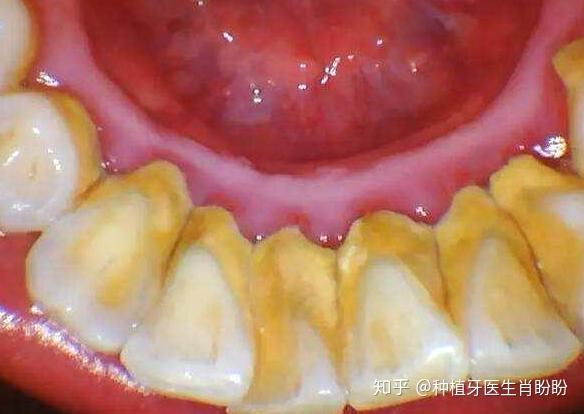 牙龈下厚厚一层污垢是什么?不洗牙,永远都不知道牙齿有多脏!