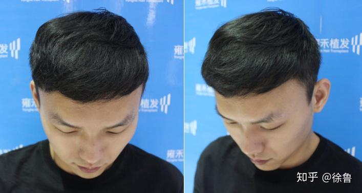 如何使发量变多? - 知乎
