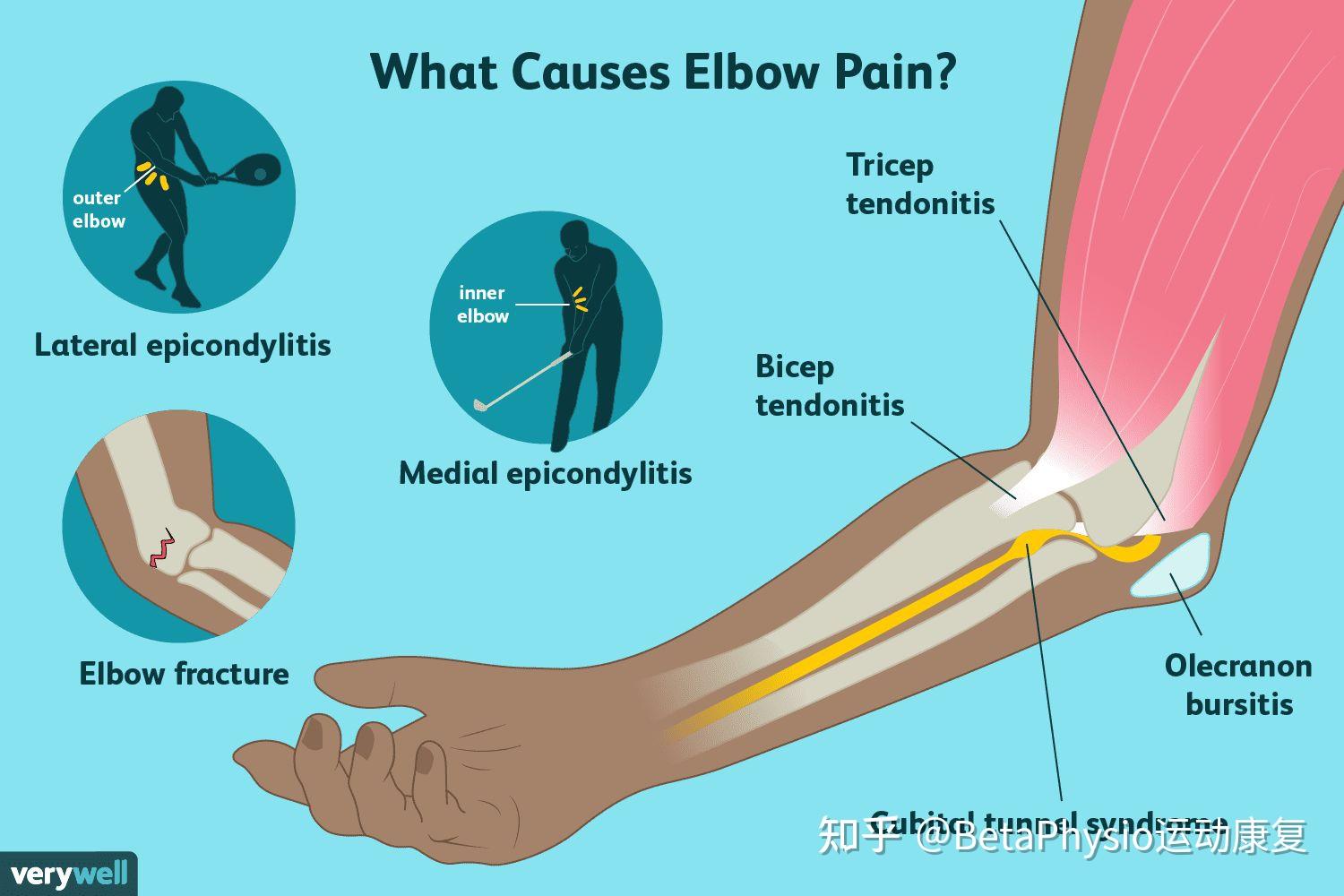 golfer-s-elbow