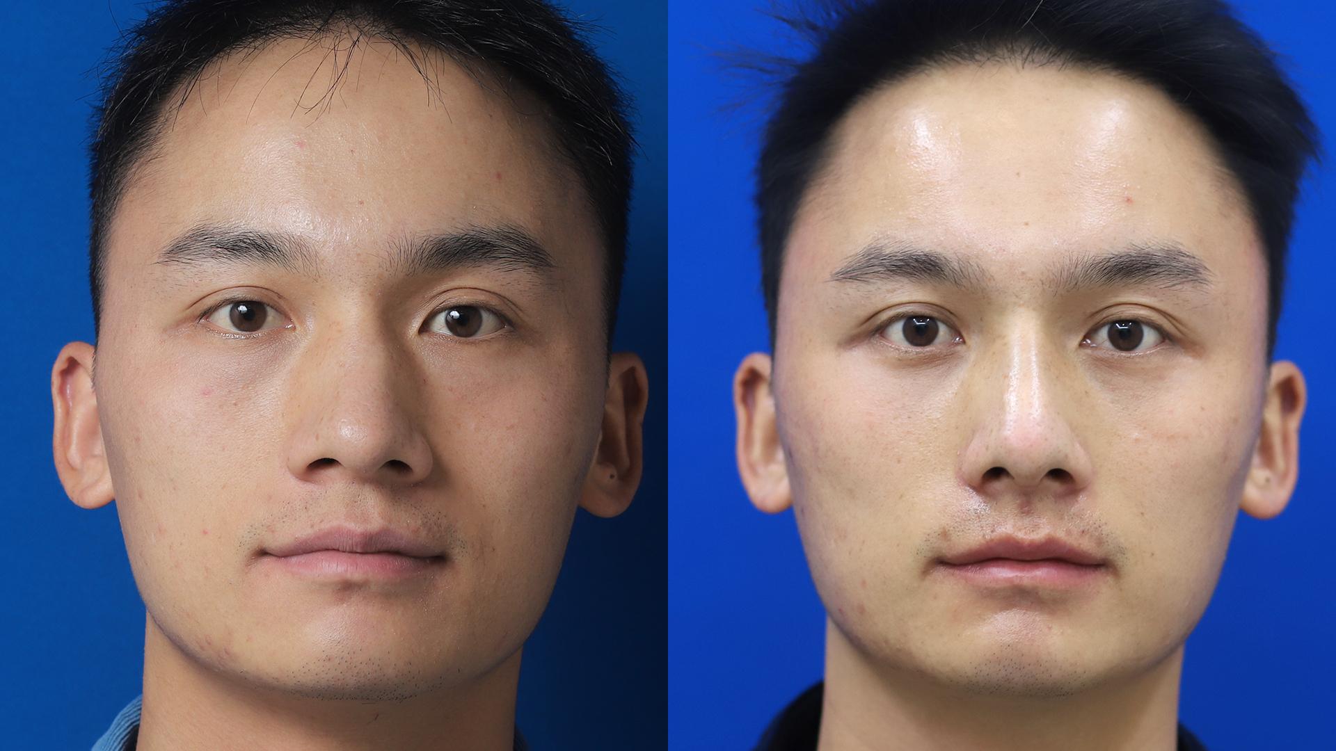 鼻骨内推,一般能达到的效果如何? - 知乎