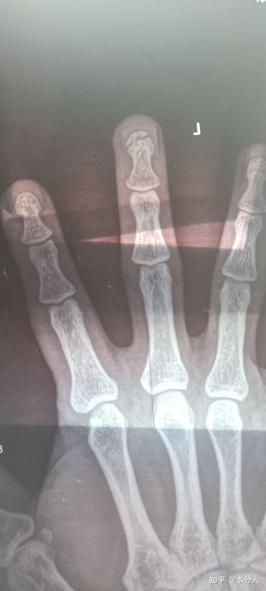 左手中指指尖指骨骨折