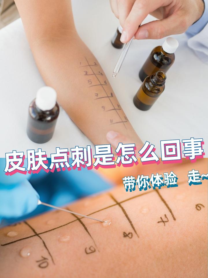 皮肤点刺试验经验总结 (过敏) - 知乎
