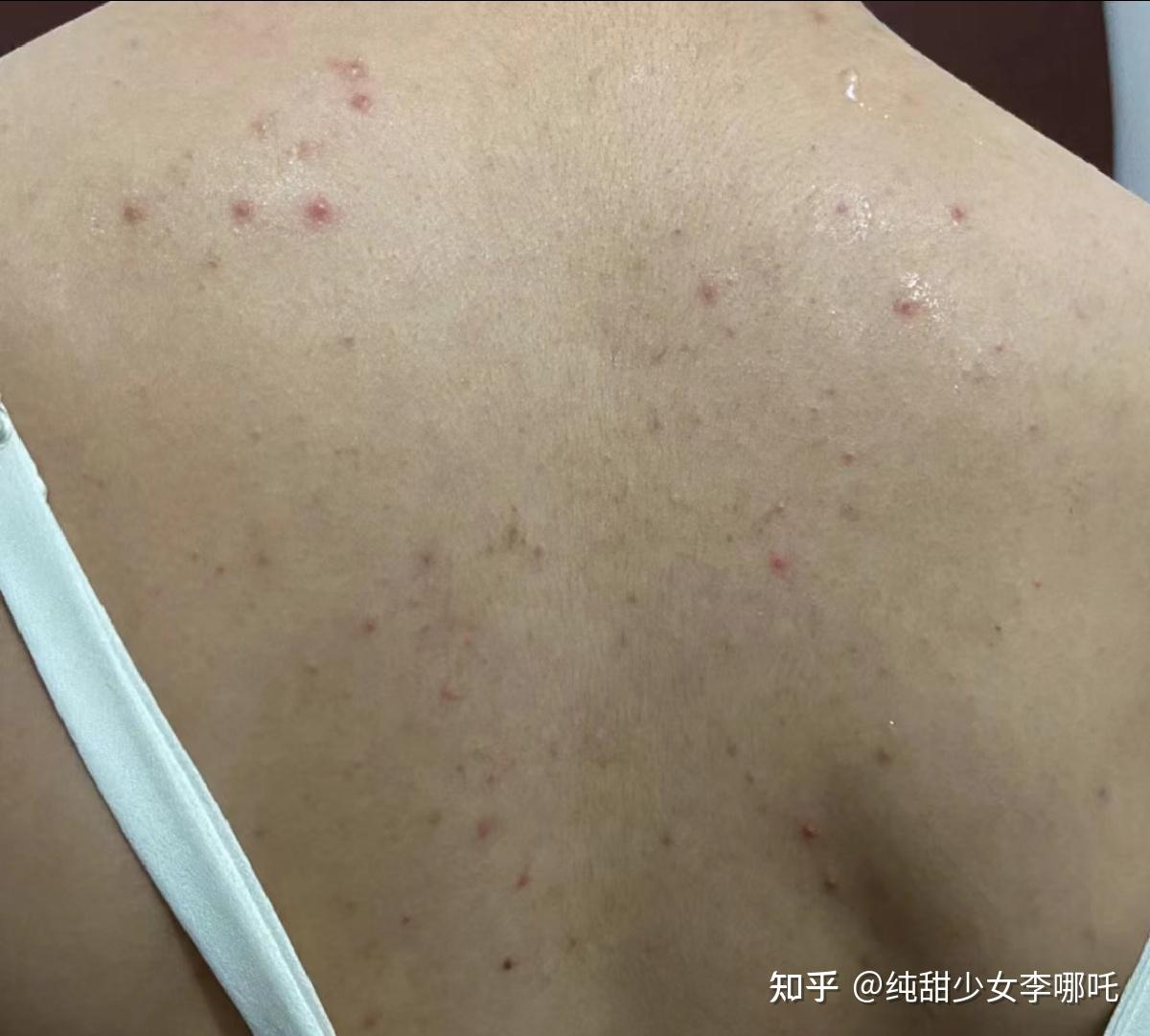 青春痘长在背上,可以用什么改善? - 知乎