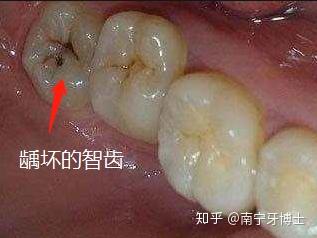 震惊 智齿不痛就不用拔 拔智齿会瘦脸 揭秘智齿的 传说 知乎