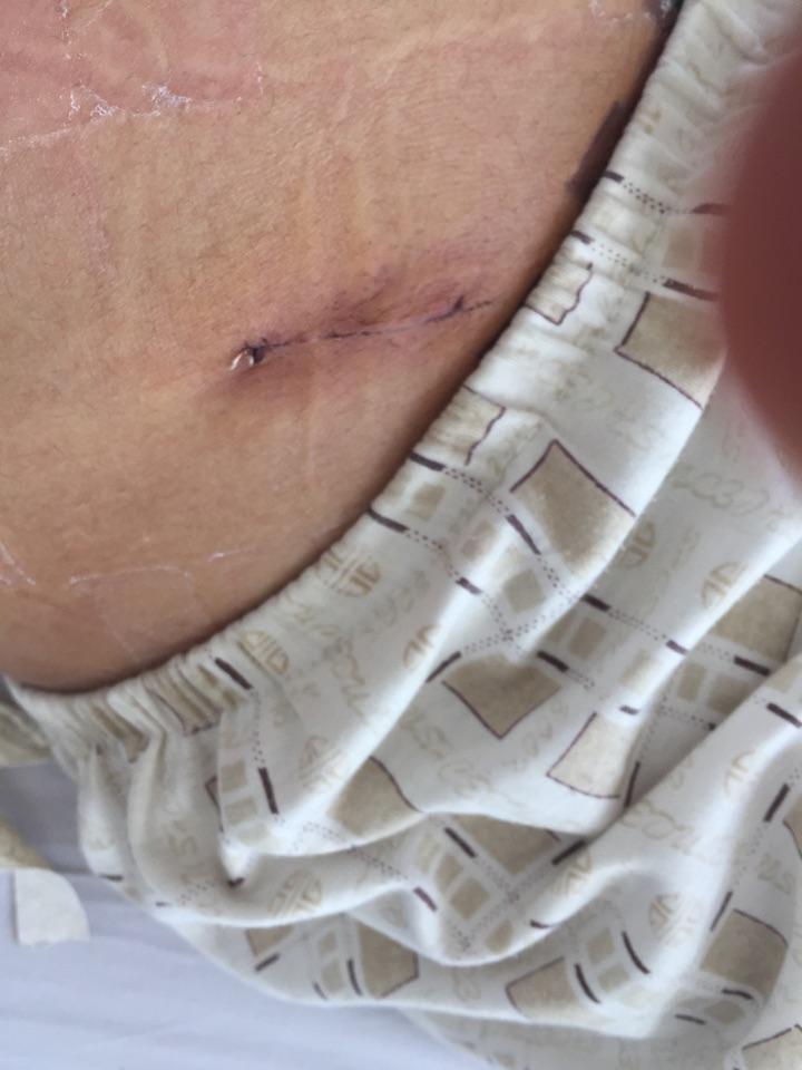 手术缝合后伤口是如何长上的?和不缝有什么区